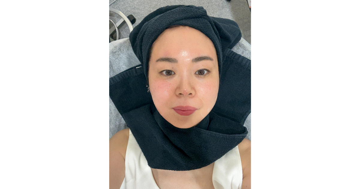 右側のみの施術後。リフトアップの効果を実感！