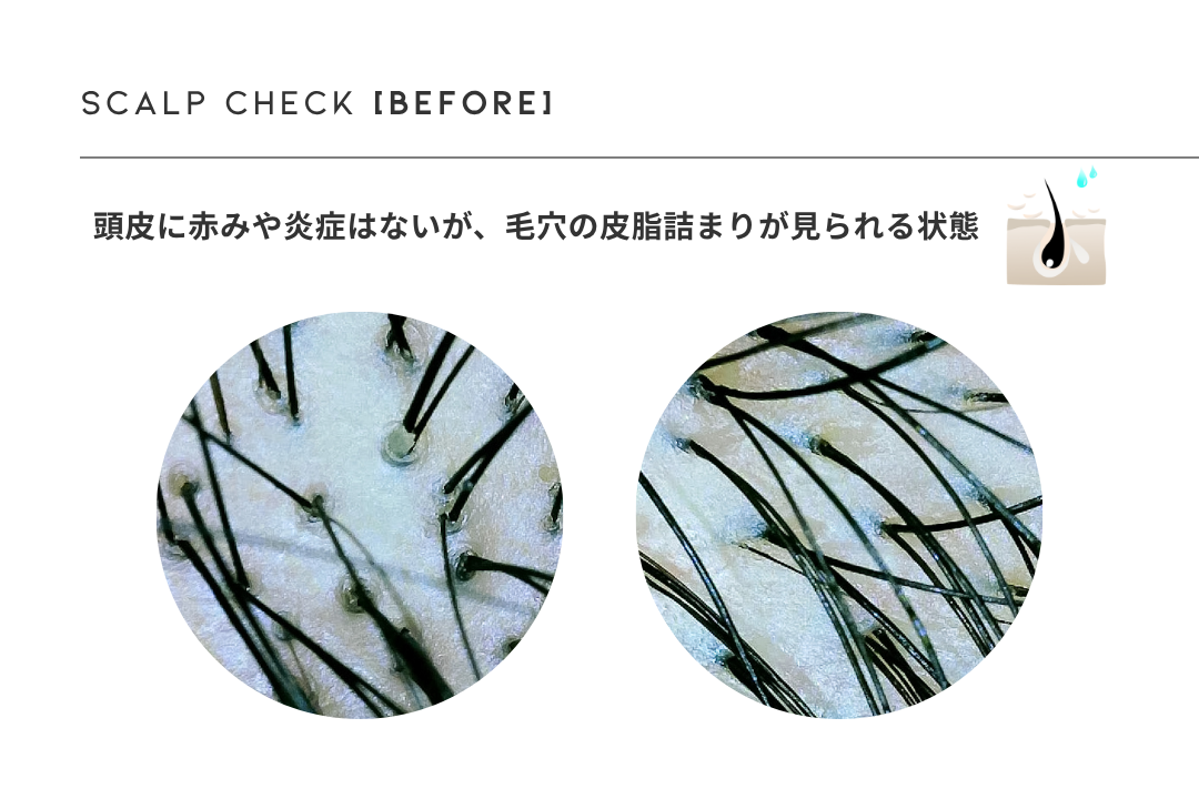 ヘッドスパ前の頭皮チェック結果